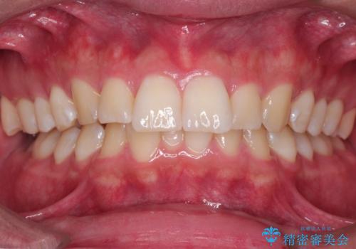 【インビザライン】短期間で出っ歯を治したいの症例 治療前