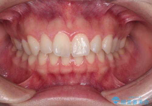 抜歯矯正をインビザラインで実現の治療前