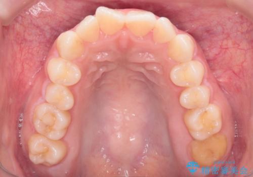 抜歯矯正をインビザラインで実現の治療前