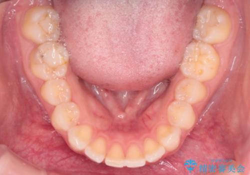 抜歯矯正をインビザラインで実現の治療前