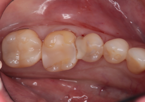 フロスが通らない　即日セラミックインレーの治療前
