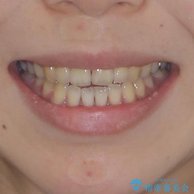 開咬をワイヤー装置で矯正治療の治療前(顔貌)