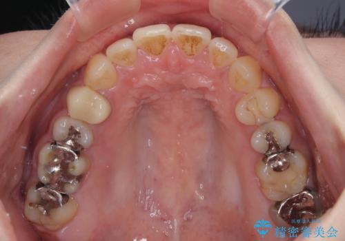 開咬をワイヤー装置で矯正治療の治療前
