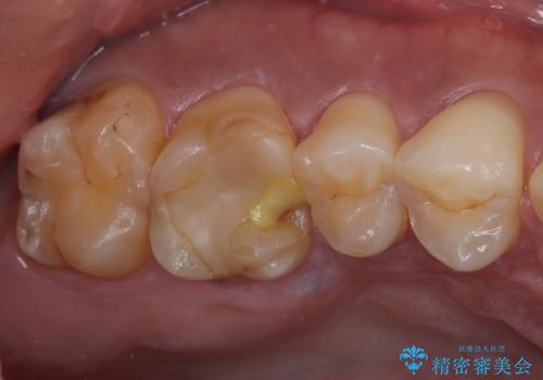 セラミックの詰め物が割れた　フルジルコニアクラウンの治療前