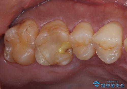 セラミックの詰め物が割れた フルジルコニアクラウンの症例 治療前