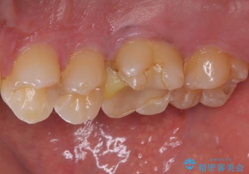 セラミックの詰め物が割れた フルジルコニアクラウンの治療前