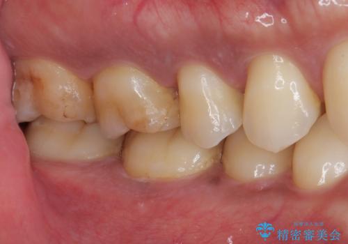 セラミックの詰め物が割れた フルジルコニアクラウンの治療前