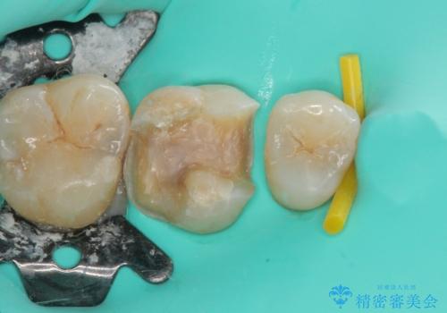 銀の詰め物が外れた ハイブリッドアンレー修復の治療中