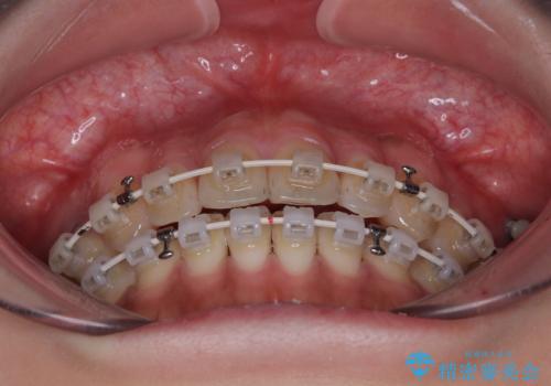 開咬をワイヤー装置で矯正治療の治療中