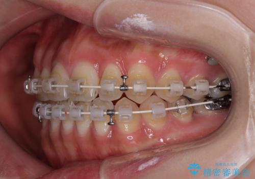 開咬をワイヤー装置で矯正治療の治療中