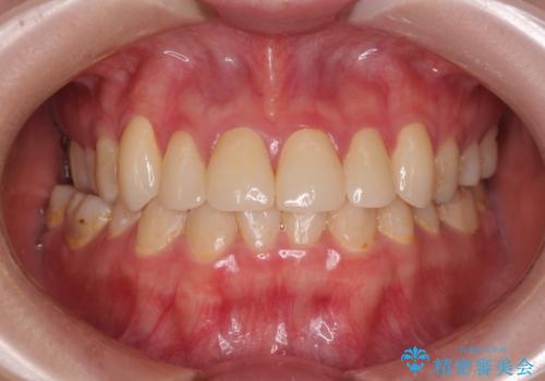 上の前歯の色味が気になる オールセラミッククラウン の治療後