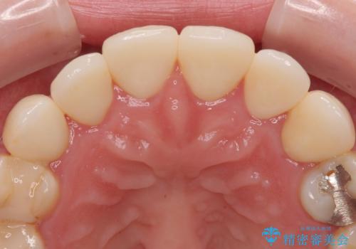 上の前歯の色味が気になる オールセラミッククラウン の治療後