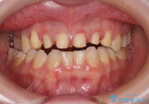 上の前歯の色味が気になる オールセラミッククラウン の治療中