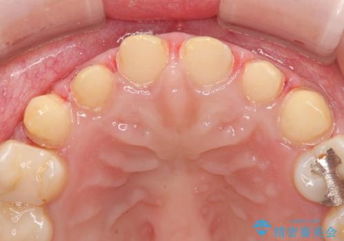 上の前歯の色味が気になる オールセラミッククラウン の治療中