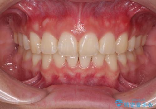 口元が出ているのを改善したい。 クリアブラケットによる抜歯矯正の症例 治療後