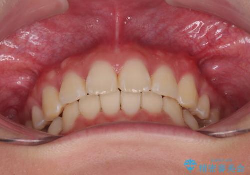 口元が出ているのを改善したい。 クリアブラケットによる抜歯矯正の治療後