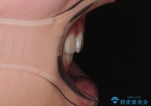 口元が出ているのを改善したい。 クリアブラケットによる抜歯矯正の治療後