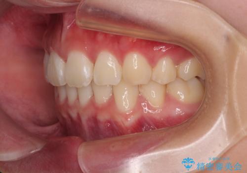 口元が出ているのを改善したい。 クリアブラケットによる抜歯矯正の治療後