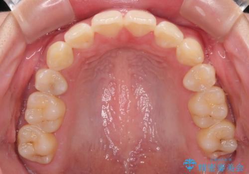 口元が出ているのを改善したい。 クリアブラケットによる抜歯矯正の治療後