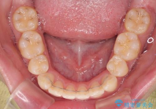 口元が出ているのを改善したい。 クリアブラケットによる抜歯矯正の治療後