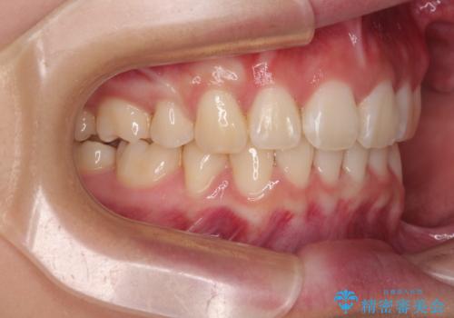 口元が出ているのを改善したい。 クリアブラケットによる抜歯矯正の治療後