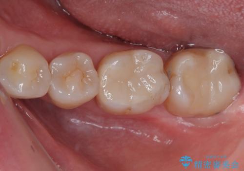 銀歯が目立つのでやり替えたい セラミックインレー修復の症例 治療後