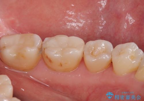 銀歯が目立つのでやり替えたい　セラミックインレー修復の治療後