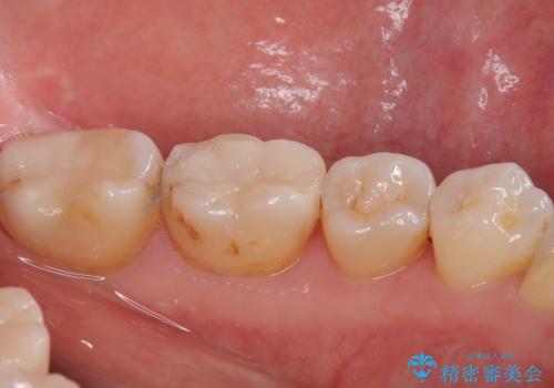 銀歯が目立つのでやり替えたい セラミックインレー修復の治療後