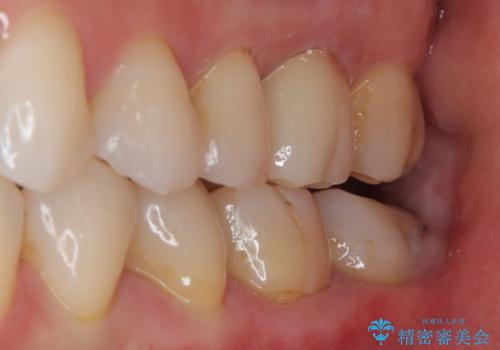 銀歯が目立つのでやり替えたい セラミックインレー修復の治療後
