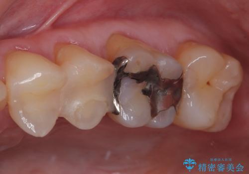 銀歯がとれた セラミックインレー修復の治療前