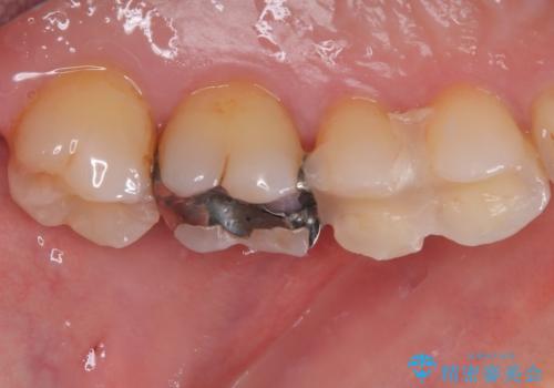銀歯がとれた セラミックインレー修復の治療前