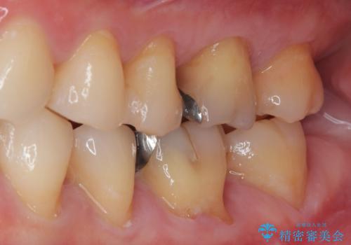 銀歯がとれた セラミックインレー修復の治療前