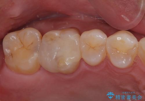 銀の詰め物が外れた ハイブリッドアンレー修復の症例 治療後