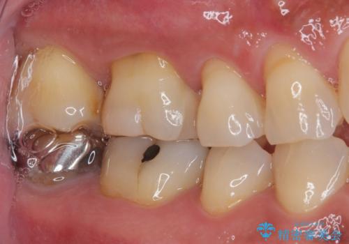 銀の詰め物が外れた　ハイブリッドアンレー修復の治療後