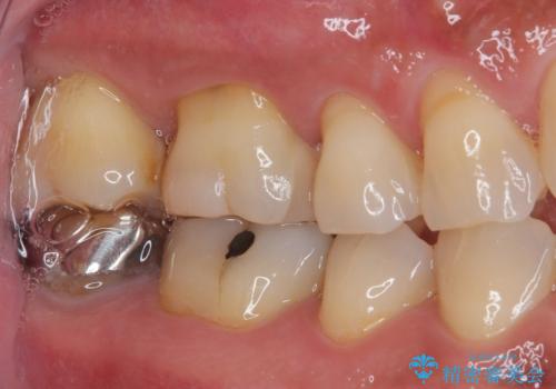 銀の詰め物が外れた ハイブリッドアンレー修復の治療後