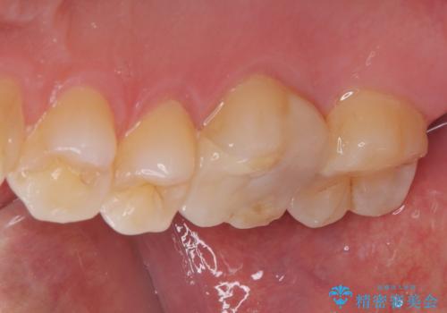 銀の詰め物が外れた ハイブリッドアンレー修復の治療後