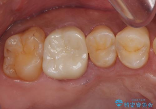 セラミックの詰め物が割れた　フルジルコニアクラウン