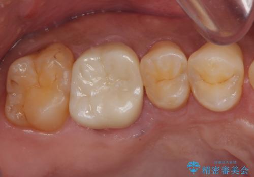 セラミックの詰め物が割れた フルジルコニアクラウンの症例 治療後