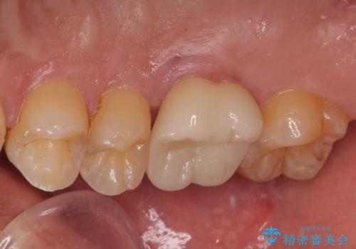 セラミックの詰め物が割れた フルジルコニアクラウンの治療後