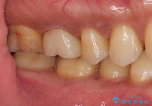 セラミックの詰め物が割れた フルジルコニアクラウンの治療後