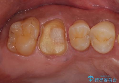 セラミックの詰め物が割れた フルジルコニアクラウンの治療中