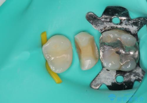 銀歯がとれた セラミックインレー修復の治療中