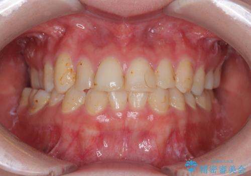 上の前歯の色味が気になる オールセラミッククラウン の治療前