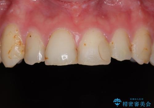 上の前歯の色味が気になる　オールセラミッククラウン　の症例 治療前