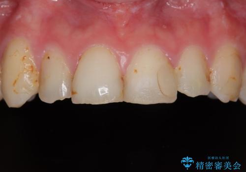 上の前歯の色味が気になる オールセラミッククラウン の症例 治療前