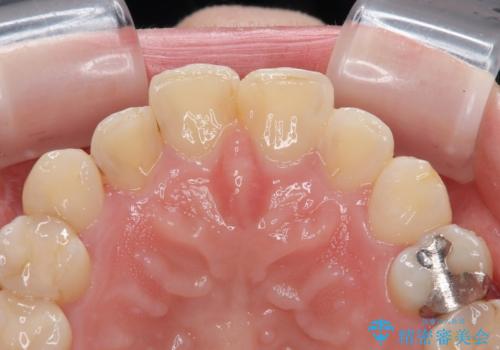 上の前歯の色味が気になる オールセラミッククラウン の治療前