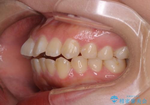 どこで噛んだらいいのかわからない:ワイヤーによる矯正治療の治療前