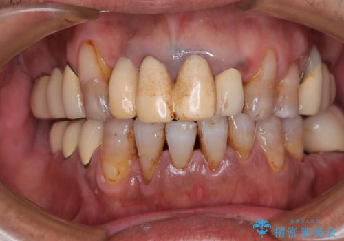 仮歯が汚くて転院 前歯のオールセラミッククラウン治療の治療前