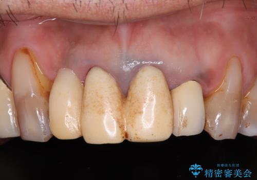仮歯が汚くて転院 前歯のオールセラミッククラウン治療の症例 治療前