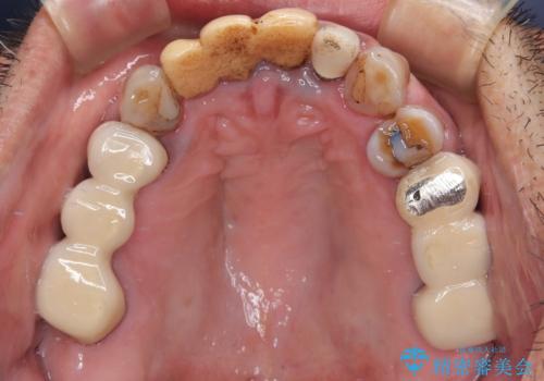 仮歯が汚くて転院 前歯のオールセラミッククラウン治療の治療前